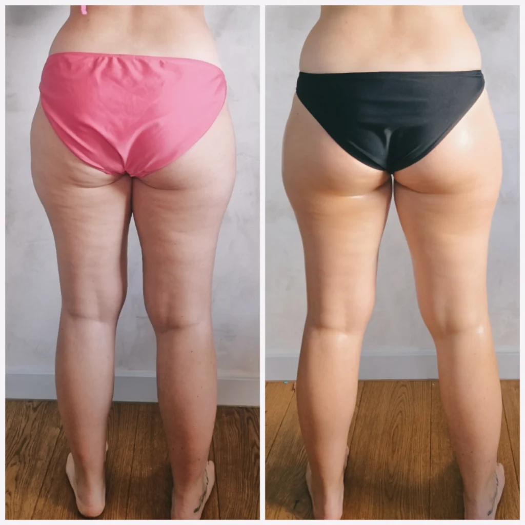 Limfomodeling Karpacz – jak przygotować się do pierwszego zabiegu i czego się spodziewać